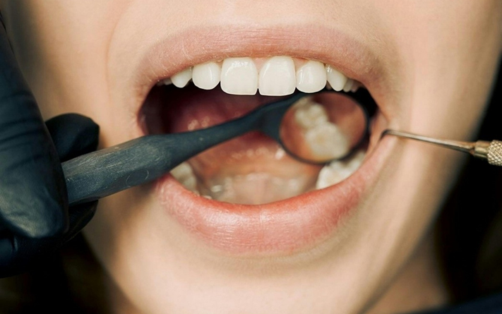 Saúde bucal: Por que minha gengiva sangra? Vejas dicas e orientações para cuidar de forma adequada