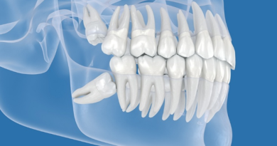 Por que algumas pessoas têm dente do siso, mas outras nunca desenvolvem?