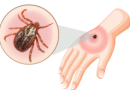 Quais são os sintomas da febre maculosa?